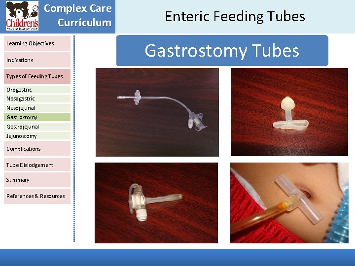 Complex Care Curriculum Learning Objectives Indications Types of Feeding Tubes Orogastric Nasojejunal Gastrostomy Gastrojejunal Complex Care Curriculum Learning Objectives Indications Types of Feeding Tubes Orogastric Nasojejunal Gastrostomy Gastrojejunal