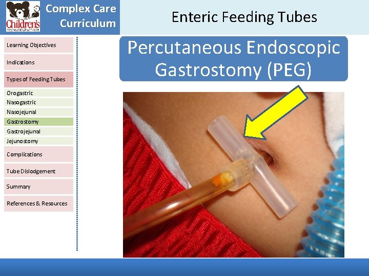 Complex Care Curriculum Learning Objectives Indications Types of Feeding Tubes Orogastric Nasojejunal Gastrostomy Gastrojejunal