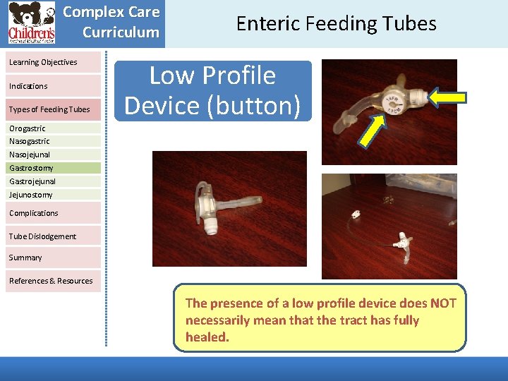 Complex Care Curriculum Learning Objectives Indications Types of Feeding Tubes Enteric Feeding Tubes Low Complex Care Curriculum Learning Objectives Indications Types of Feeding Tubes Enteric Feeding Tubes Low