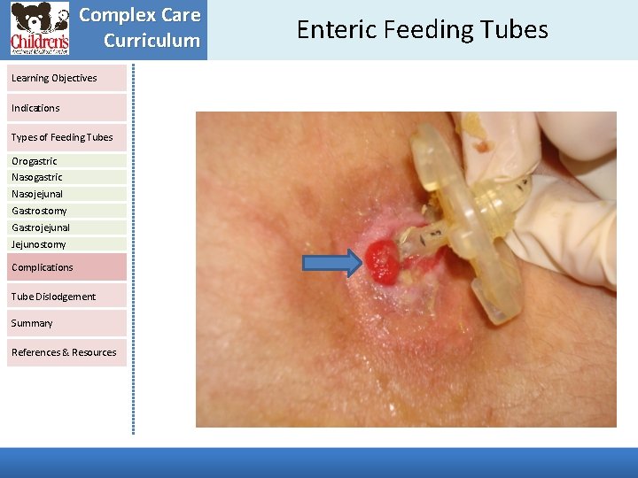 Complex Care Curriculum Learning Objectives Indications Types of Feeding Tubes Orogastric Nasojejunal Gastrostomy Gastrojejunal