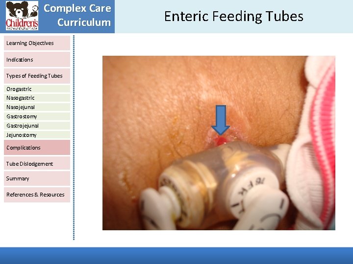 Complex Care Curriculum Learning Objectives Indications Types of Feeding Tubes Orogastric Nasojejunal Gastrostomy Gastrojejunal Complex Care Curriculum Learning Objectives Indications Types of Feeding Tubes Orogastric Nasojejunal Gastrostomy Gastrojejunal
