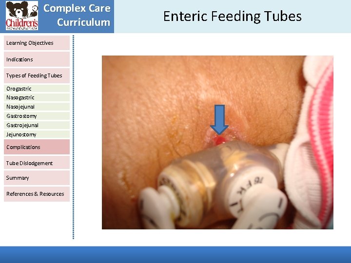 Complex Care Curriculum Learning Objectives Indications Types of Feeding Tubes Orogastric Nasojejunal Gastrostomy Gastrojejunal