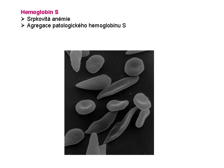 Hemoglobin S Ø Srpkovitá anémie Ø Agregace patologického hemoglobinu S 