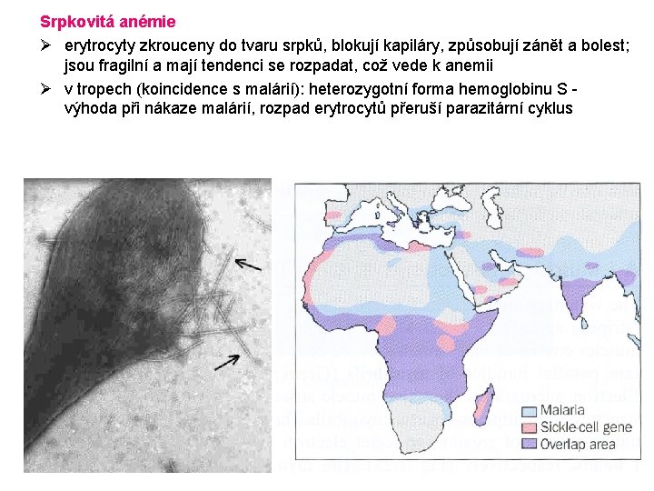 Srpkovitá anémie Ø erytrocyty zkrouceny do tvaru srpků, blokují kapiláry, způsobují zánět a bolest;