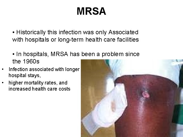 MRSA • Historically this infection was only Associated with hospitals or long-term health care