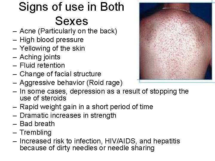 – – – – Signs of use in Both Sexes Acne (Particularly on the