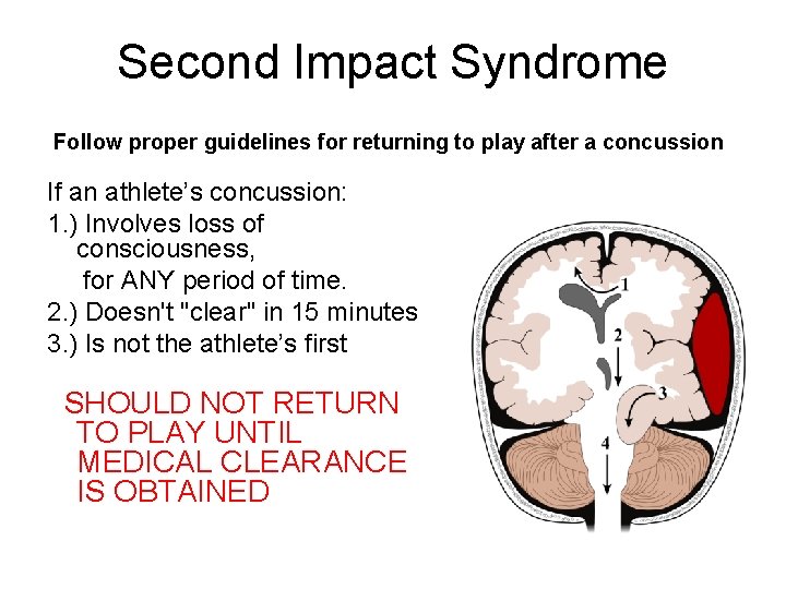 Second Impact Syndrome Follow proper guidelines for returning to play after a concussion If