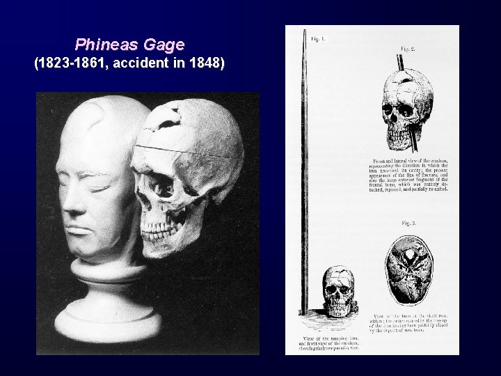 Phineas Gage (1823 -1861, accident in 1848) 