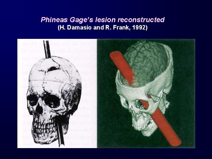 Phineas Gage’s lesion reconstructed (H. Damasio and R. Frank, 1992) 