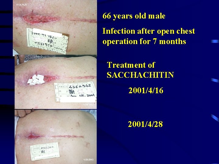 66 years old male Infection after open chest operation for 7 months Treatment of