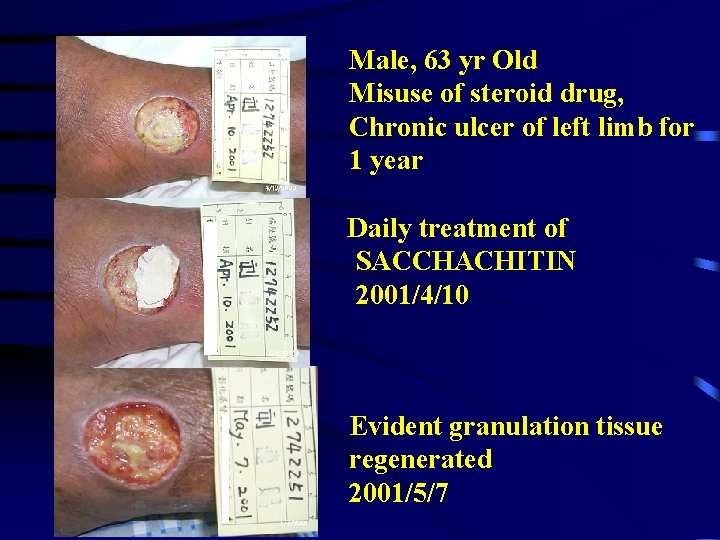 Male, 63 yr Old Misuse of steroid drug, Chronic ulcer of left limb for