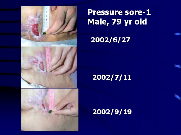 Pressure sore-1 Male, 79 yr old 2002/6/27 2002/7/11 2002/9/19 