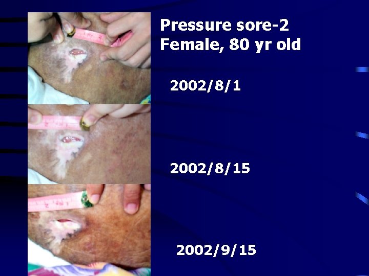 Pressure sore-2 Female, 80 yr old 2002/8/15 2002/9/15 