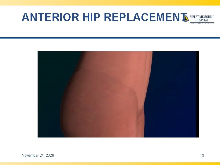 ANTERIOR HIP REPLACEMENT November 24, 2020 13 