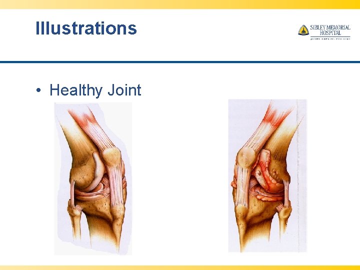 Illustrations • Healthy Joint Diseased Joint 
