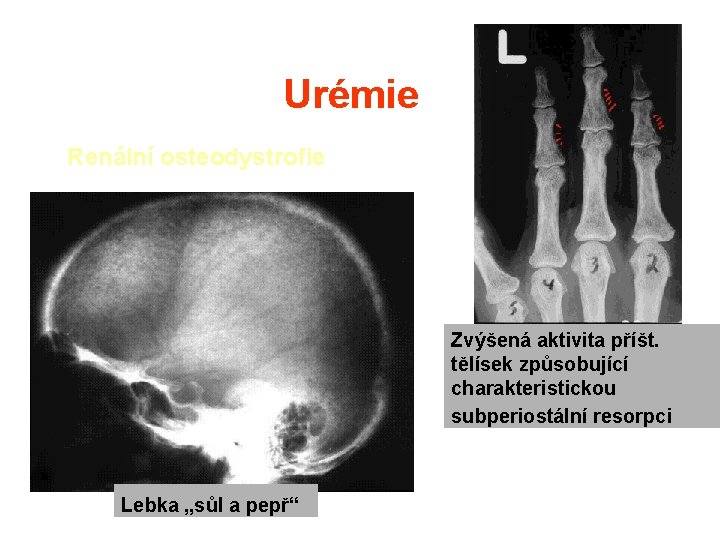 Urémie Renální osteodystrofie Zvýšená aktivita příšt. tělísek způsobující charakteristickou subperiostální resorpci Lebka „sůl a