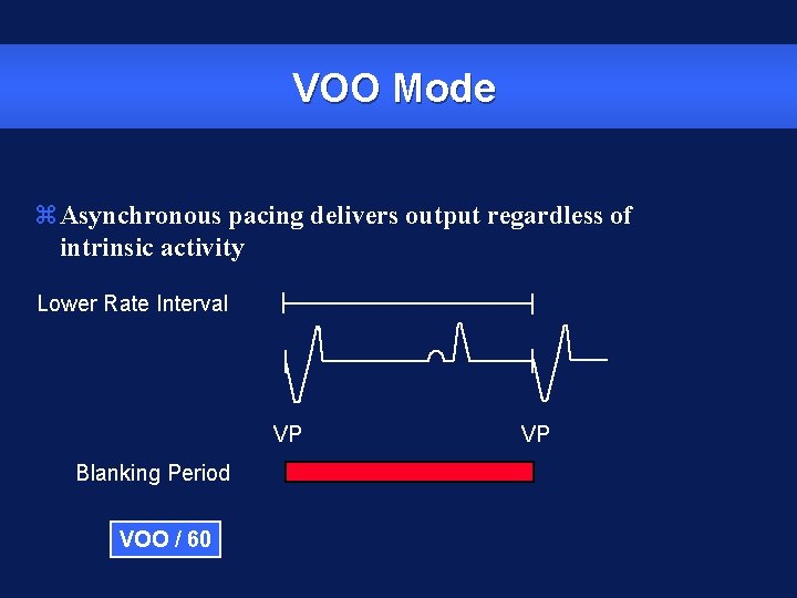 VOO Mode z. Asynchronous pacing delivers output regardless of intrinsic activity Lower Rate Interval