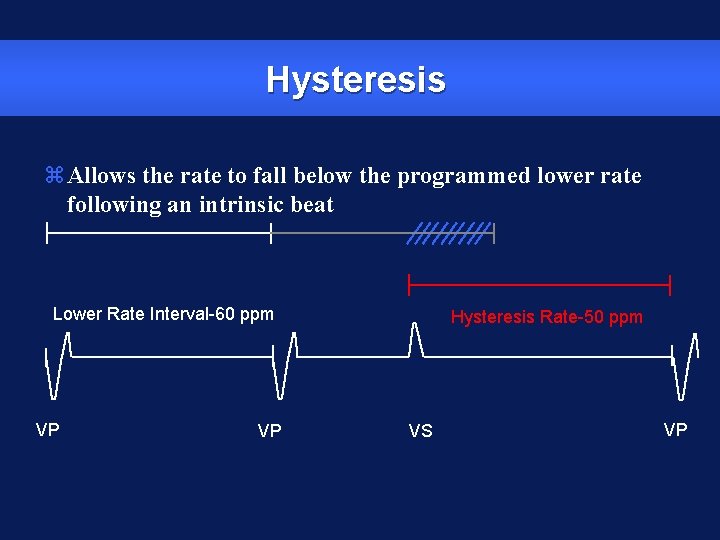 Hysteresis z. Allows the rate to fall below the programmed lower rate following an