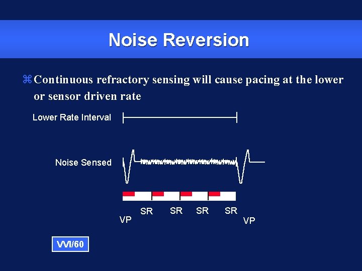 Noise Reversion z. Continuous refractory sensing will cause pacing at the lower or sensor