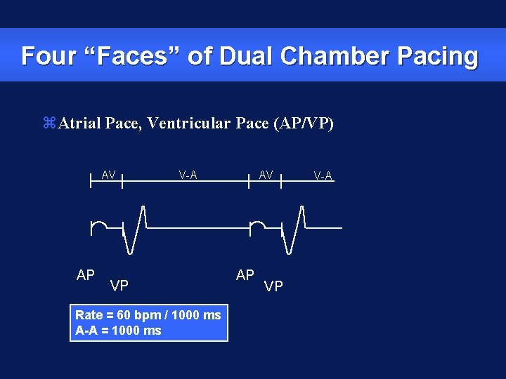 Four “Faces” of Dual Chamber Pacing z. Atrial Pace, Ventricular Pace (AP/VP) AV AP