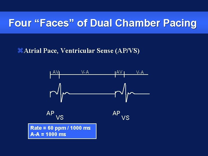 Four “Faces” of Dual Chamber Pacing z. Atrial Pace, Ventricular Sense (AP/VS) AV AP