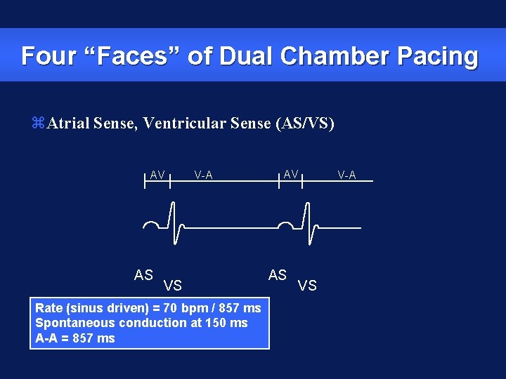 Four “Faces” of Dual Chamber Pacing z. Atrial Sense, Ventricular Sense (AS/VS) AV AS