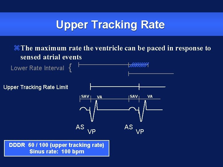 Upper Tracking Rate z. The maximum rate the ventricle can be paced in response