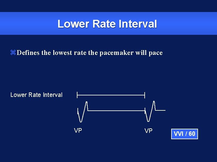 Lower Rate Interval z. Defines the lowest rate the pacemaker will pace Lower Rate