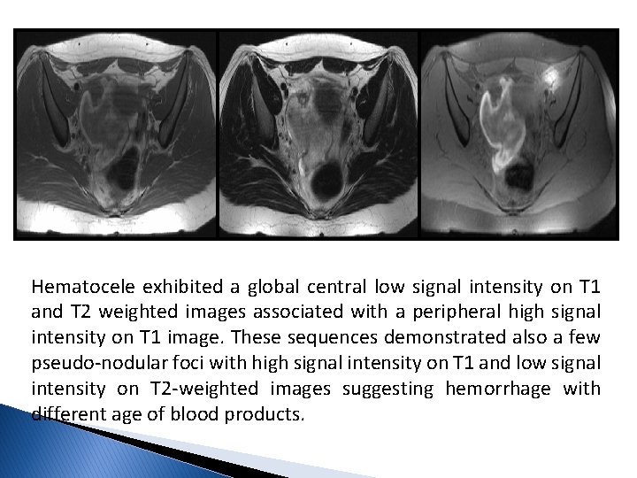 Hematocele exhibited a global central low signal intensity on T 1 and T 2