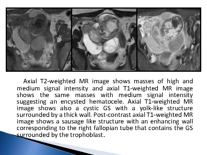 Axial T 2 -weighted MR image shows masses of high and medium signal intensity