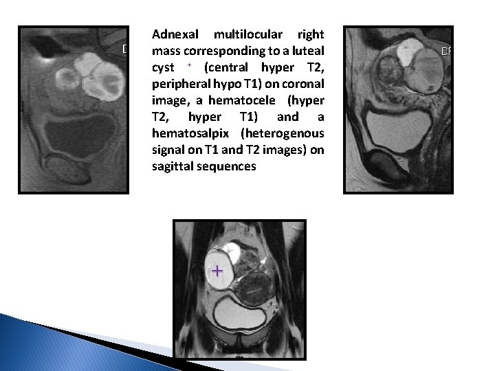 Adnexal multilocular right mass corresponding to a luteal cyst + (central hyper T 2,