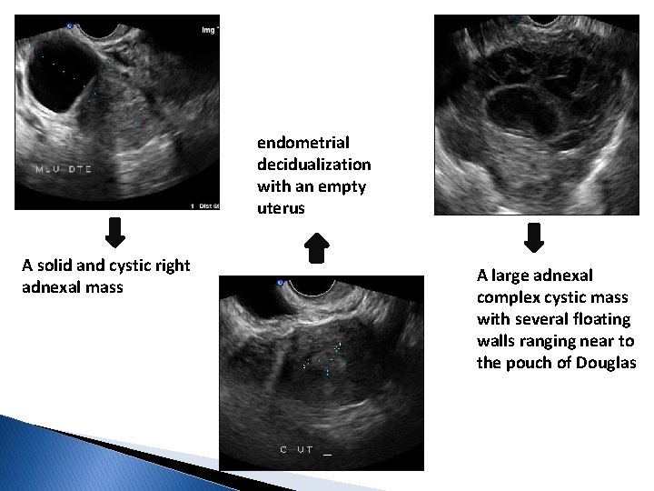 endometrial decidualization with an empty uterus A solid and cystic right adnexal mass A