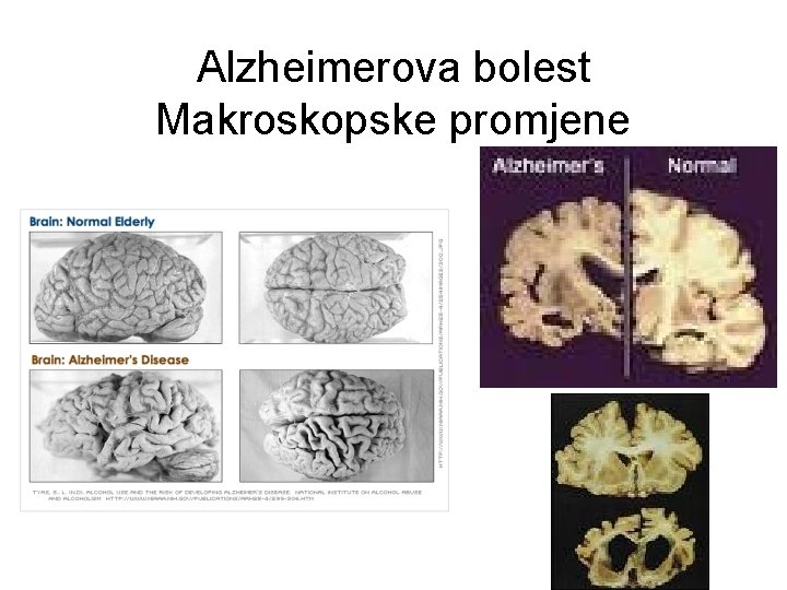 Alzheimerova bolest Makroskopske promjene Težina mozga u AB < 1100 g. 