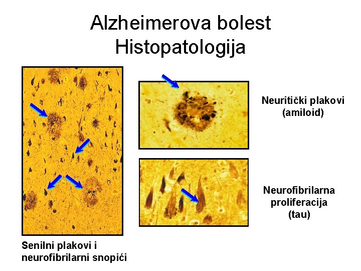 Alzheimerova bolest Histopatologija Neuritički plakovi (amiloid) Neurofibrilarna proliferacija (tau) Senilni plakovi i neurofibrilarni snopići