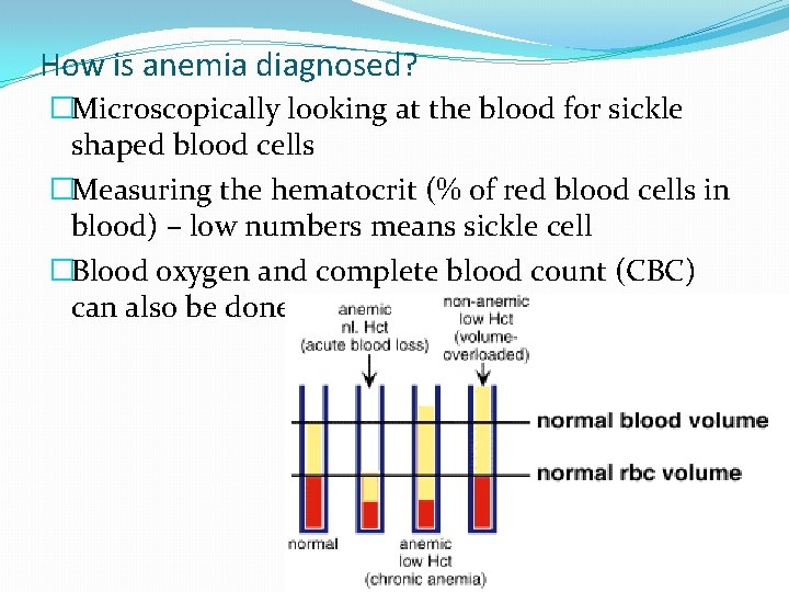 How is anemia diagnosed? �Microscopically looking at the blood for sickle shaped blood cells