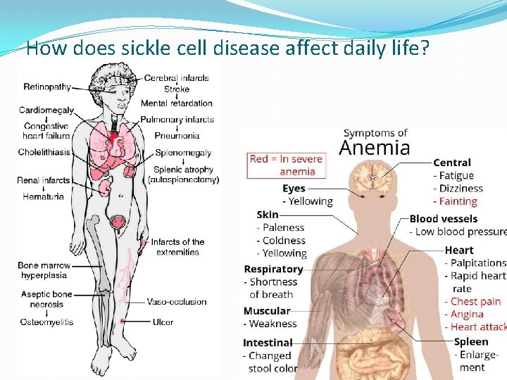 How does sickle cell disease affect daily life? 