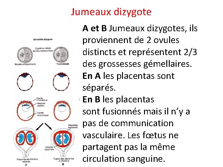 Jumeaux dizygote A et B Jumeaux dizygotes, ils proviennent de 2 ovules distincts et