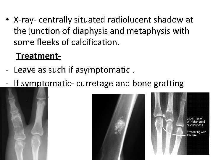  • X-ray- centrally situated radiolucent shadow at the junction of diaphysis and metaphysis