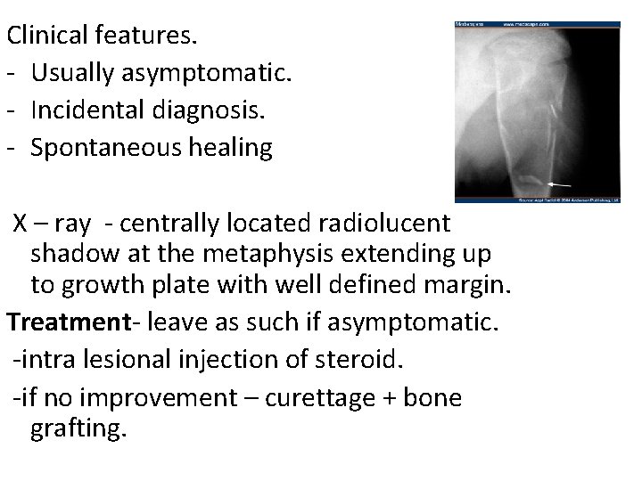 Clinical features. - Usually asymptomatic. - Incidental diagnosis. - Spontaneous healing X – ray