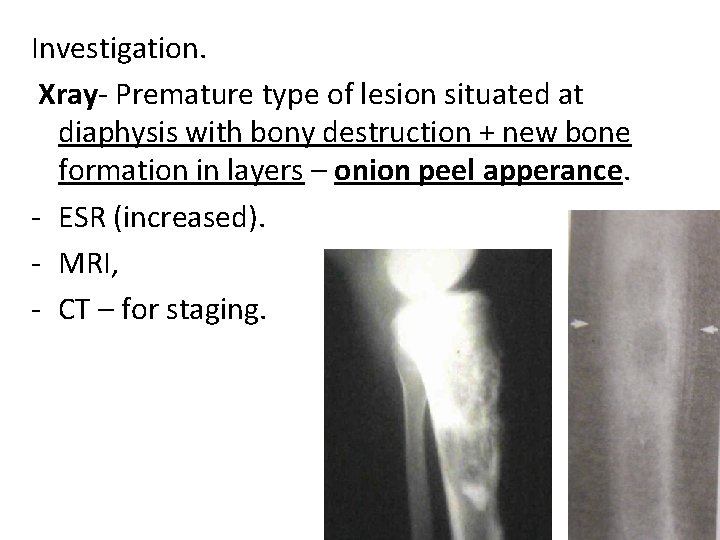 Investigation. Xray- Premature type of lesion situated at diaphysis with bony destruction + new