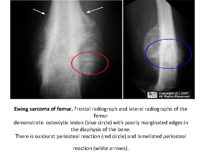 Ewing sarcoma of femur. Frontal radiograph and lateral radiographs of the femur demonstrate osteolytic