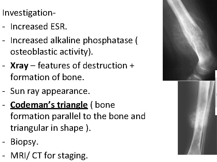 Investigation- Increased ESR. - Increased alkaline phosphatase ( osteoblastic activity). - Xray – features