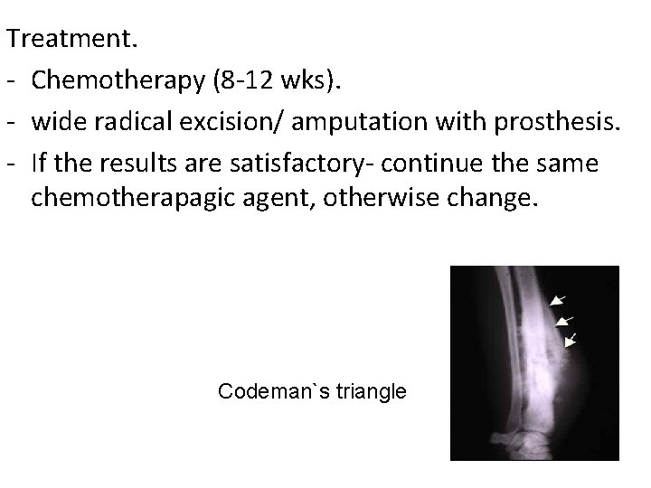 Treatment. - Chemotherapy (8 -12 wks). - wide radical excision/ amputation with prosthesis. -