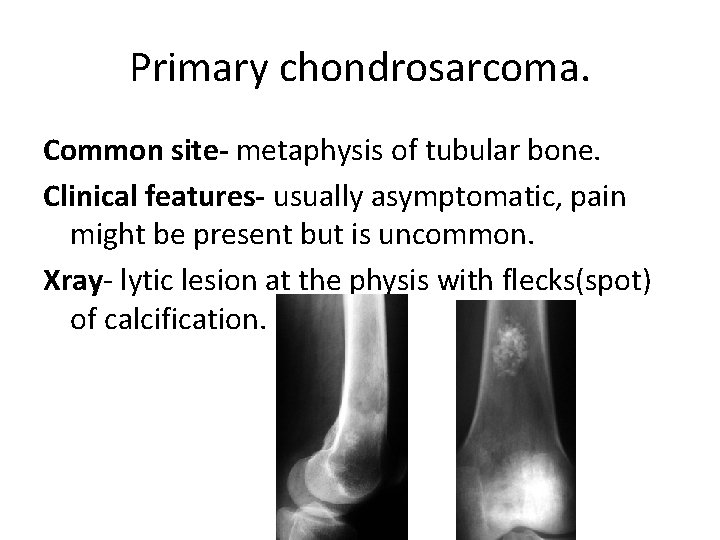 Primary chondrosarcoma. Common site- metaphysis of tubular bone. Clinical features- usually asymptomatic, pain might