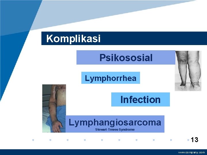 Komplikasi Psikososial Lymphorrhea Infection Lymphangiosarcoma Stewart-Treves Syndrome 13 www. company. com 