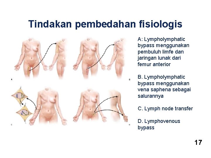 Tindakan pembedahan fisiologis A: Lympholymphatic bypass menggunakan pembuluh limfe dan jaringan lunak dari femur