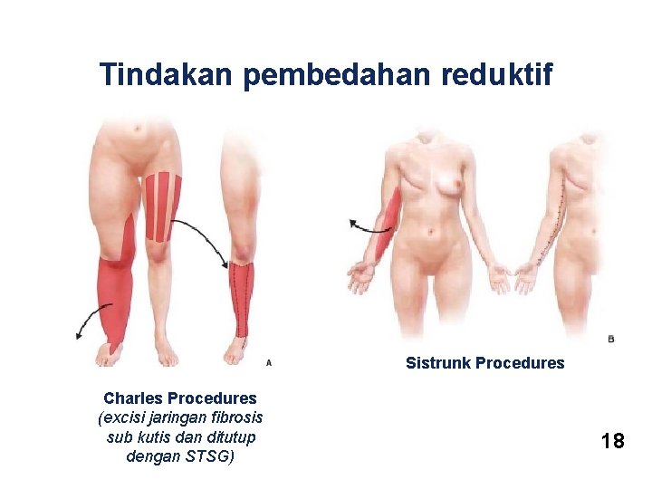 Tindakan pembedahan reduktif Sistrunk Procedures Charles Procedures (excisi jaringan fibrosis sub kutis dan ditutup