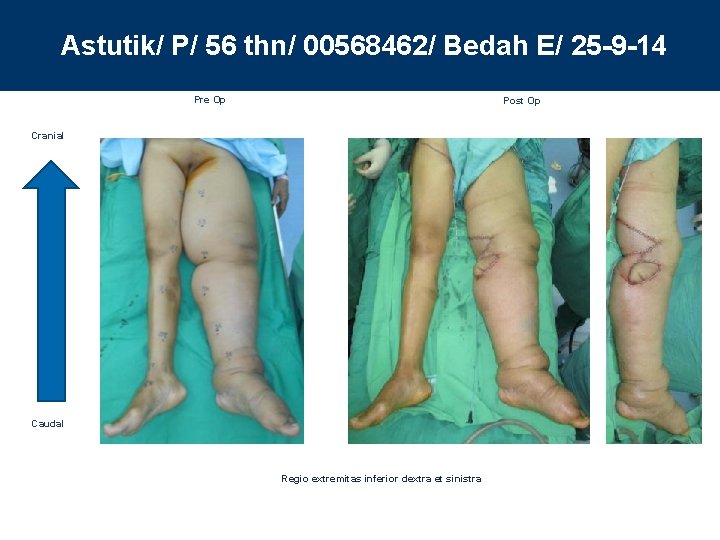 Astutik/ P/ 56 thn/ 00568462/ Bedah E/ 25 -9 -14 Pre Op Post Op