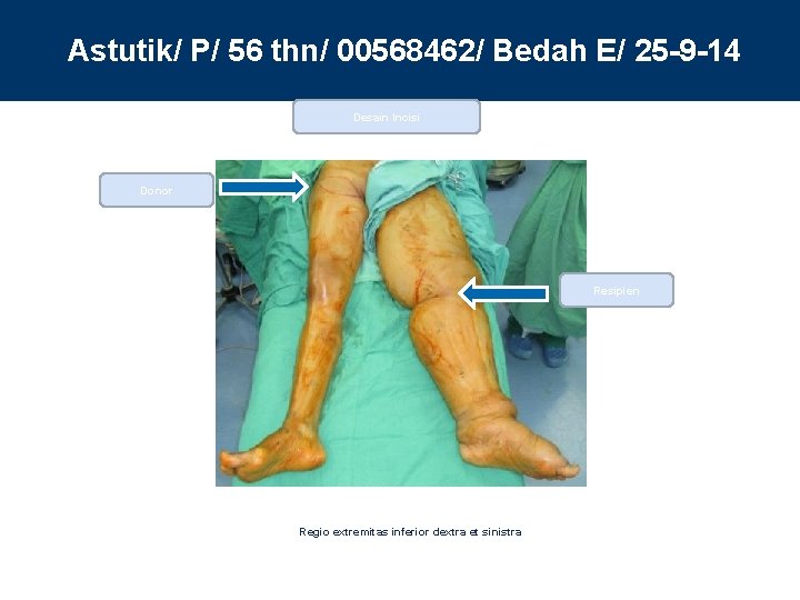 Astutik/ P/ 56 thn/ 00568462/ Bedah E/ 25 -9 -14 Desain Incisi Donor Resipien