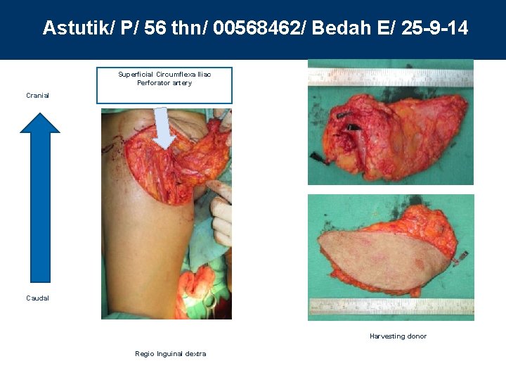 Astutik/ P/ 56 thn/ 00568462/ Bedah E/ 25 -9 -14 Superficial Circumflexa Iliac Perforator
